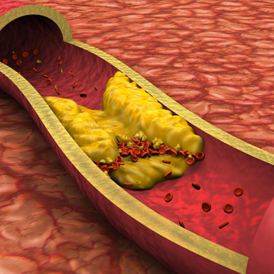 Effects of Growth Hormone on Cholesterol Levels