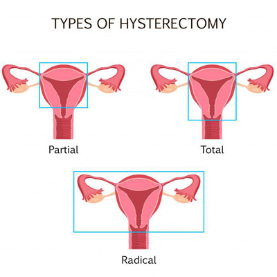 Hormone Replacement Therapy After Hysterectomy