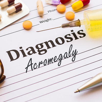 Can Too Much Growth Hormone Cause Acromegaly?