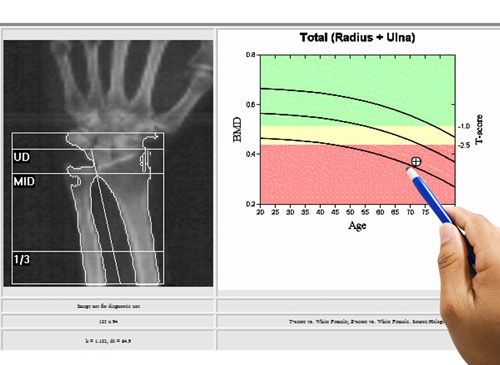 Does HGH Increase Bone Density