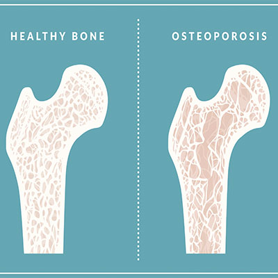 HGH and Osteoporosis – Improve Your Bone Health