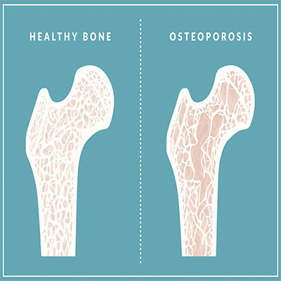 HGH and Osteoporosis – Improve Your Bone Health