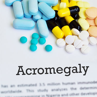 Symptoms of Acromegaly