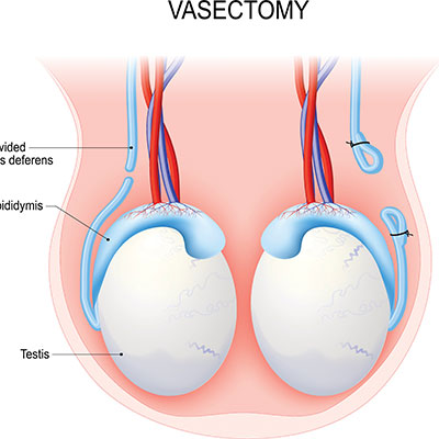 Does a Vasectomy Lower Testosterone Production