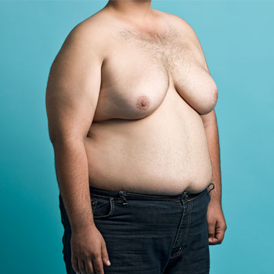 Gynecomastia