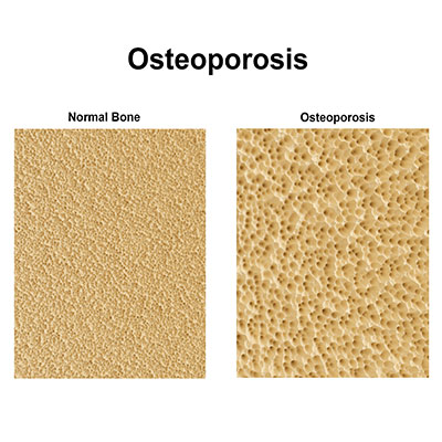 What does Osteoporosis Look Like.