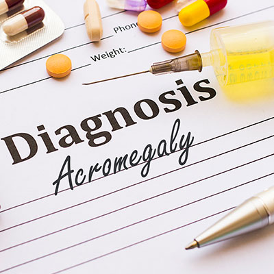 Acromegaly or Gigantism.